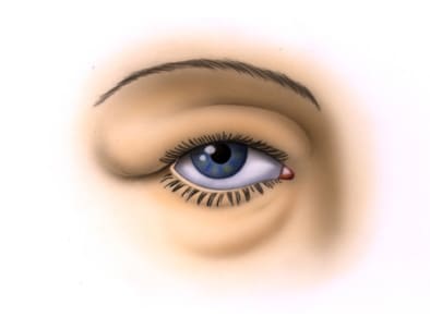 Les indications pour une blépharoplastie