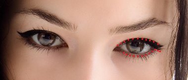 Canthoplastie