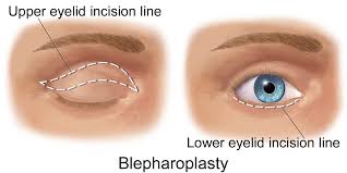 Esthétique : la blépharoplastie pour un visage aux traits « occidentaux »