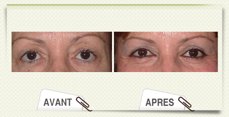 photos Blepharoplastie