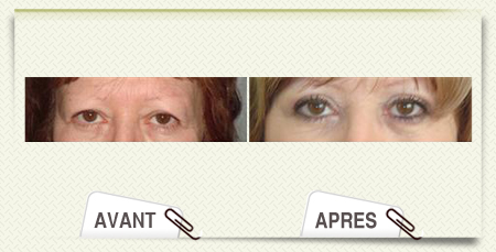 Blepharoplastie photo